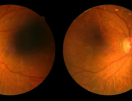 Vis&atilde;o Dia Mundial do Diabetes refor&ccedil;a alerta sobre a retinopatia diab&eacute;tica